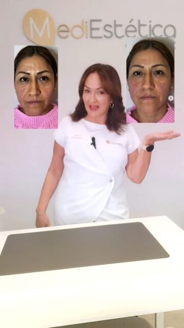 Estamos aquí para mejorar, no para cambiar quién eres.
Y como seguro que tienes dudas, nuestra primera valoración es completamente gratuita✨☎️ 687 05 06 55
📍C/Serafín Álvarez Campana 2 El Puerto de Santa María
⚪NICA 64604#fisioterapia #nutricion #medicinaestetica #tratamientosestéticos #mediestetica #elpuerto #belleza #tratamientos #estetica #tratamientosfaciales #manchasenlapiel #manchas #eliminarmanchas #Arrugas #ElPuertodeSantaMaria #Elpuerto #CentroEstetico #EsteticaFacial #TratamientoFacial