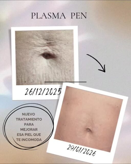 Diste a luz, perdiste peso, y ese abdomen ya no volvió a ser el mismo. ✨¿Cómo que no? Es un tratamiento rápido, sencillo e indoloro.🌼Aquí tenemos el antes y después, tras 5 semanas del abdomen de nuestra compañera Rosa.
Y aún tiene que ir a mejor.Pásate, seguro que este verano luces 👙☎️ 687 05 06 55#plasmapen #arrugasabdomen #postparto