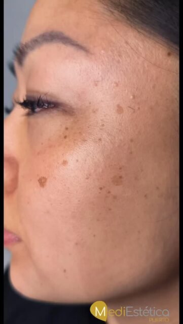 Nunca fue tan fácil deshacerte de las manchas, queratosis...que te incomodan, en tu rostro, tus manos.

Incorporamos nueva técnica,  Plasma Pen Oficial, un dispositivo que emite un arco de plasma y sin ni siquiera tocar la piel hace esta magia.😇😇

¿Quieres saber si tus manchas las podemos tratar? Ven a vernos o envíanos una foto, te valoramos y te decimos cuánto  te va a costar 💵💵

☎️ 687 05 06 55 

📍C/ Serafín Álvarez Campana 2, El Puerto de Santa María 

#manchas #plasmapen #manchasenlapiel