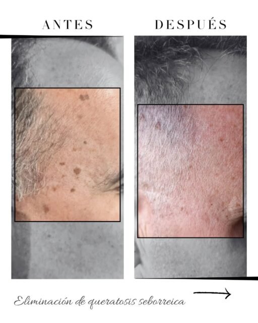 Las queratosis seborreicas son muy fáciles de eliminar, en una sola sesión.

Las eliminamos con Plasma Pen, un dispositivo que emite un arco de plasma.

Y es que tardas más en pensarlo que nosotras en quitarlas.

Para más información 

☎️ 687050655

📍 C/ Serafín Álvarez Campana N2
El Puerto de Santa María