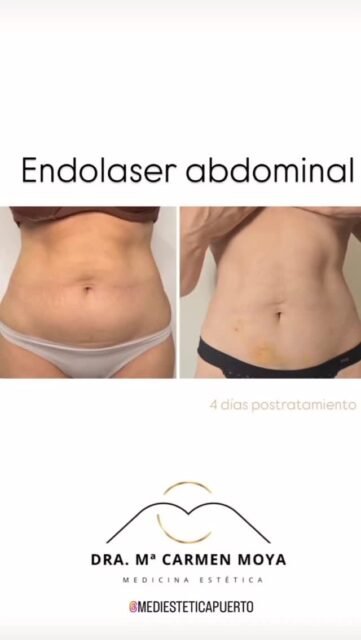 Esa grasa localizada que te trae de cabeza y que cuesta eliminarla, pues buenas noticias, ya no.

Es una intervención rápida, recuperación sin baja médica. 

¿Y a tí que zona te preocupa?
Pregúntanos y te informamos sin compromiso.

☎️ 687 05 06 55 

📍 C/ Serafín Álvarez Campana no 2
  El Puerto de Santa María