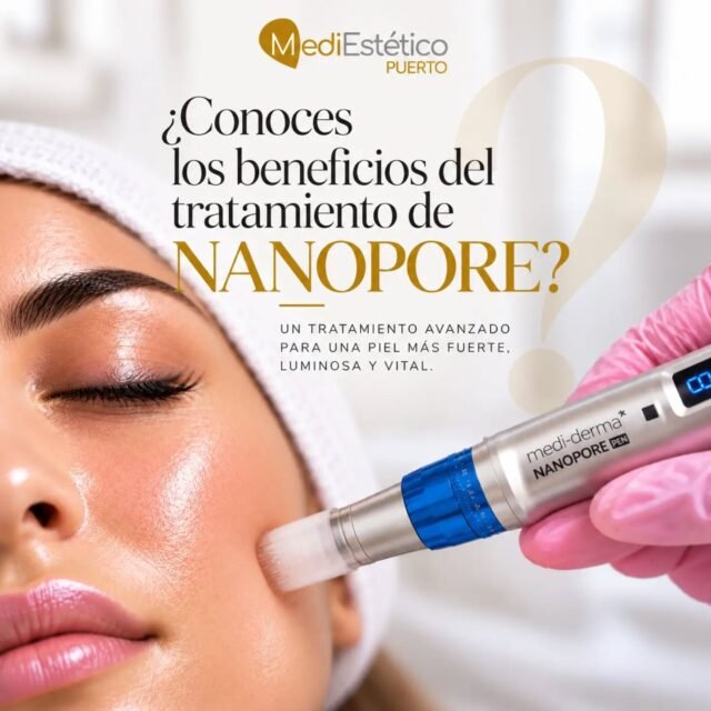 ✨ NANOPORE: ACTIVA LA RENOVACIÓN NATURAL DE TU PIEL ✨
¿Sabías que podemos estimular la capacidad de regeneración de tu piel para mejorar su calidad, textura y firmeza?
💛 Nanopore es mucho más que un tratamiento facial.
Gracias a su avanzada tecnología de micropunción, creamos microcanales controlados en la piel que activan los mecanismos naturales de reparación y estimulan la producción de colágeno y elastina.
¿CUÁLES SON SUS BENEFICIOS?
✨ Mejora la textura y suavidad de la piel.
✨ Atenúa las líneas de expresión y las arrugas finas.
✨ Ayuda a reducir la apariencia de las cicatrices de acné.
✨ Mejora el aspecto de los poros dilatados.
✨ Favorece una piel más firme y elástica.
✨ Contribuye a conseguir un tono más uniforme y una piel de aspecto rejuvenecido.
💎 EL SECRETO ESTÁ EN LA PERSONALIZACIÓN.
En Mediestética Puerto combinamos Nanopore con activos específicos, seleccionados según las necesidades de cada piel, para potenciar los objetivos del tratamiento.
Porque cada piel es única y merece un protocolo a su medida.
🤍 No se trata de cambiar tu piel, sino de ayudarla a mostrar su mejor versión.
📍 Mediestética Puerto | El Puerto de Santa María
📲 687 050 655
#Nanopore #Micropuncion #RejuvenecimientoFacial #RegeneracionCutanea #Colageno CuidadoDeLaPiel MediesteticaPuerto ElPuertoDeSantaMaria