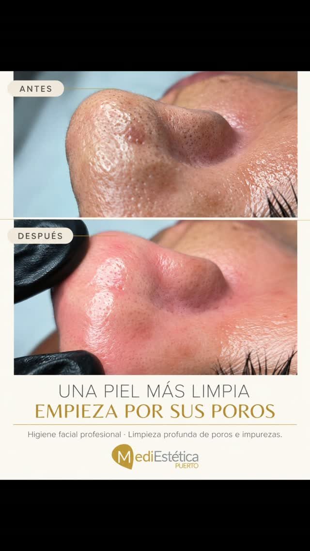✨ ¿Sabías que una piel limpia empieza por unos poros libres de impurezas?
🔎 El antes y después habla por sí solo.
La higiene facial profesional es mucho más que una simple limpieza. Nos permite trabajar en profundidad para:
✔️ Eliminar impurezas y exceso de sebo.
✔️ Extraer puntos negros y comedones.
✔️ Mejorar la textura y el aspecto de la piel.
✔️ Favorecer una piel más luminosa y uniforme.
✨ Porque una piel bonita empieza por una piel bien cuidada.
En MediEstética Puerto adaptamos cada higiene facial a las necesidades de tu piel.
📍 El Puerto de Santa María
📲 687 050 655 | Pide tu cita.
#MediEsteticaPuerto #HigieneFacial #LimpiezaFacialProfunda #AntesYDespues #CuidadoFacial ElPuertoDeSantaMaria EsteticaAvanzada