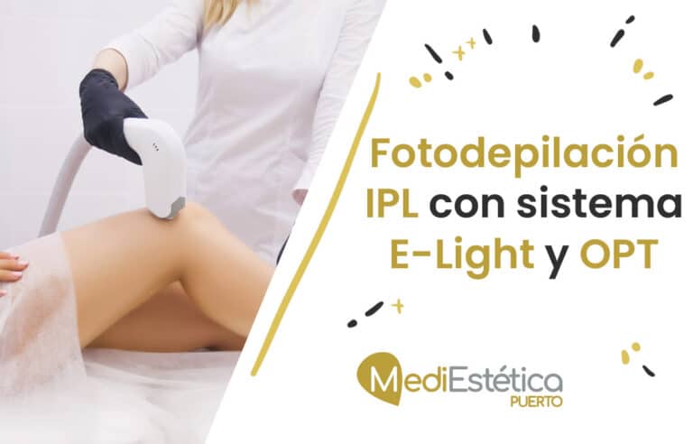 Fotodepilación IPL con sistema E-Light y OPT