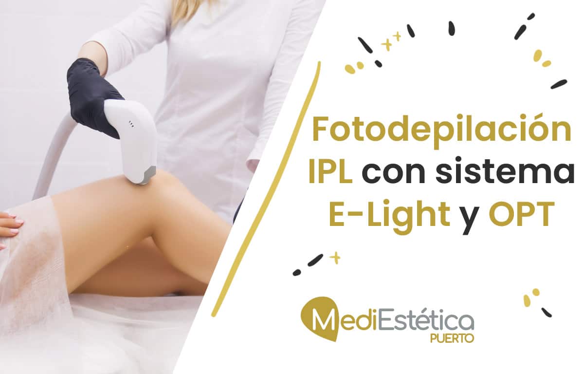 Fotodepilación IPL con sistema E-Light y OPT MediEstética Puerto ❤♡