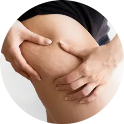 presoterapia para la celulitis