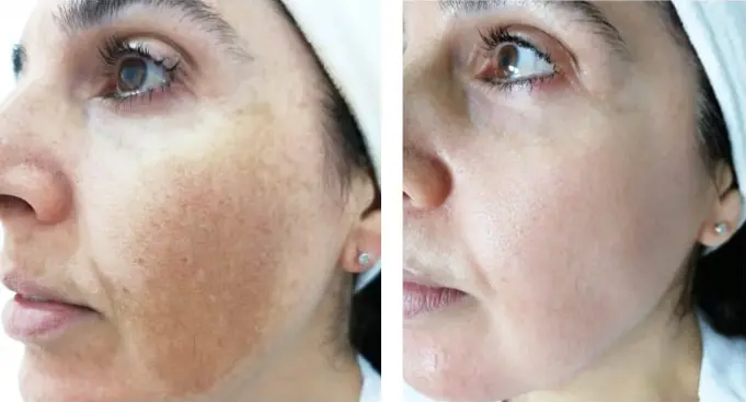 eliminación de manchas en la piel melasma