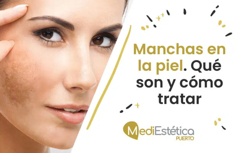 manchas en la piel qué son y cómo tratar