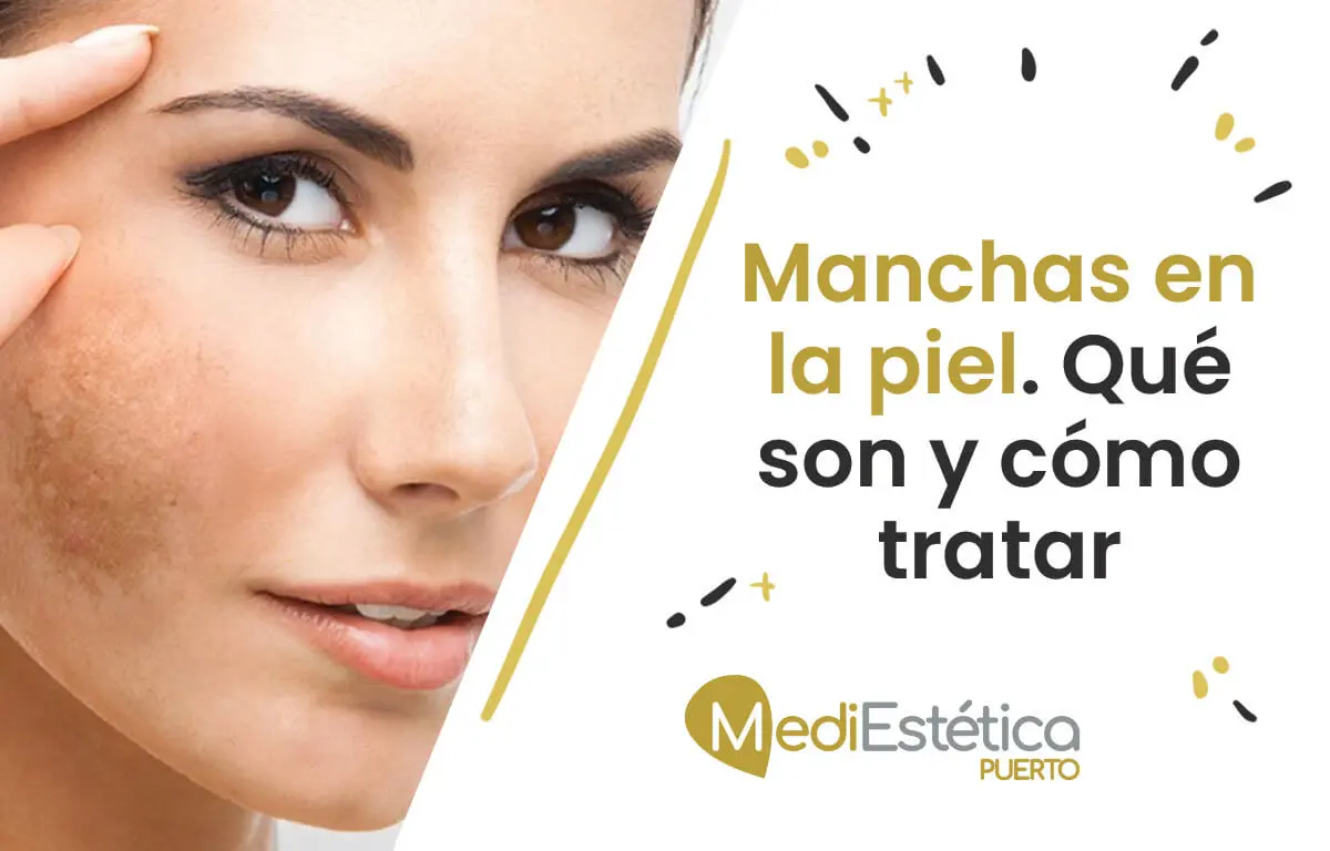 manchas en la piel qué son y cómo tratar