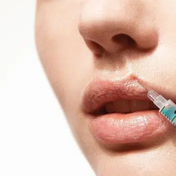 aumento de labios acido hialuronico