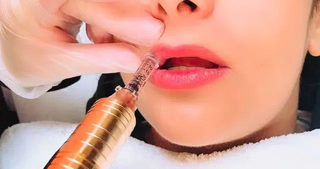 hyaluron pen medicina estética low cost