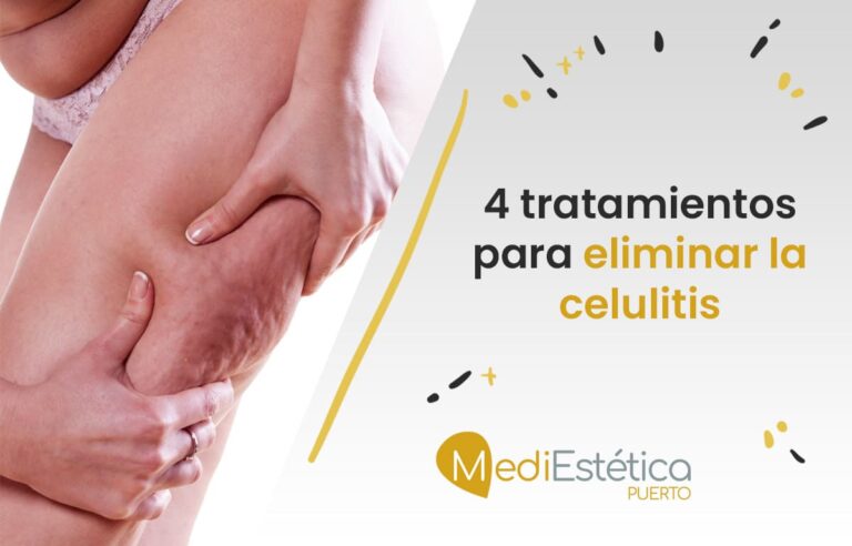 4 tratamientos para eliminar la celulitis