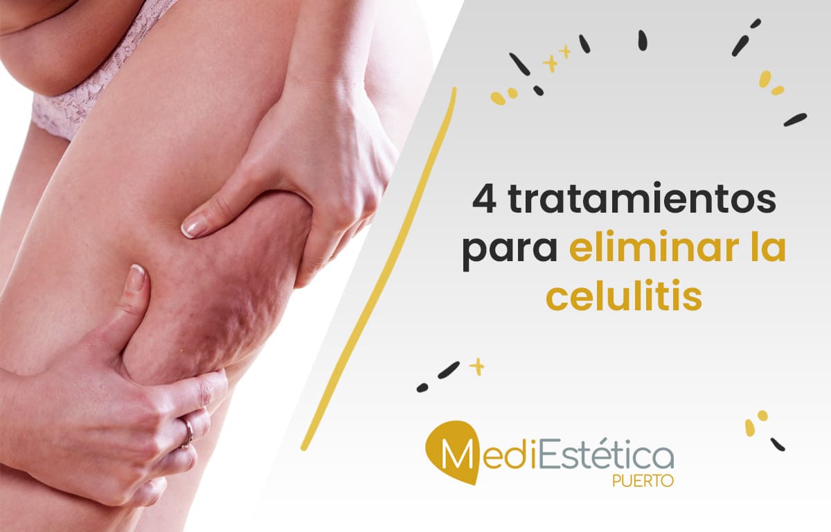 4 mejores tratamientos para eliminar la celulitis