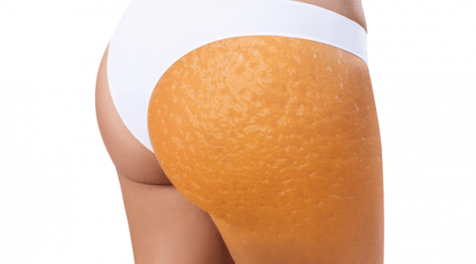 piel de naranja o celulitis