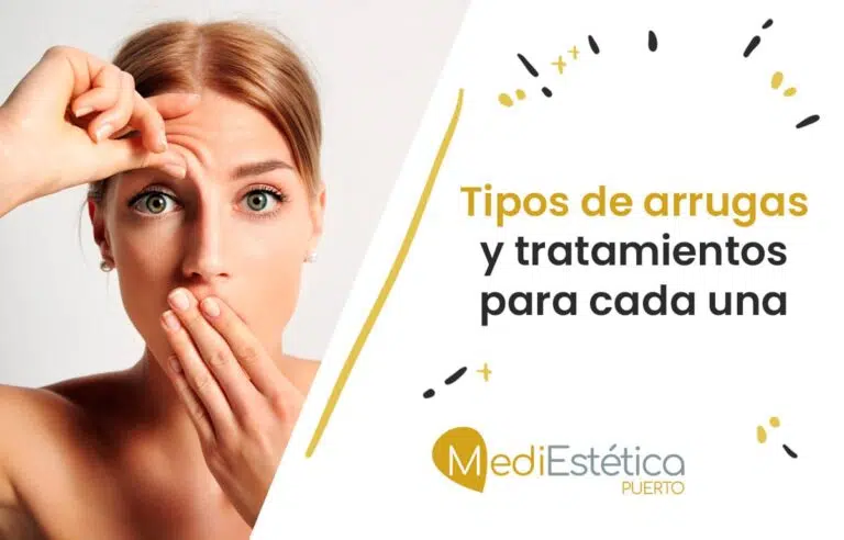tipos de arrugas y sus tratamientos