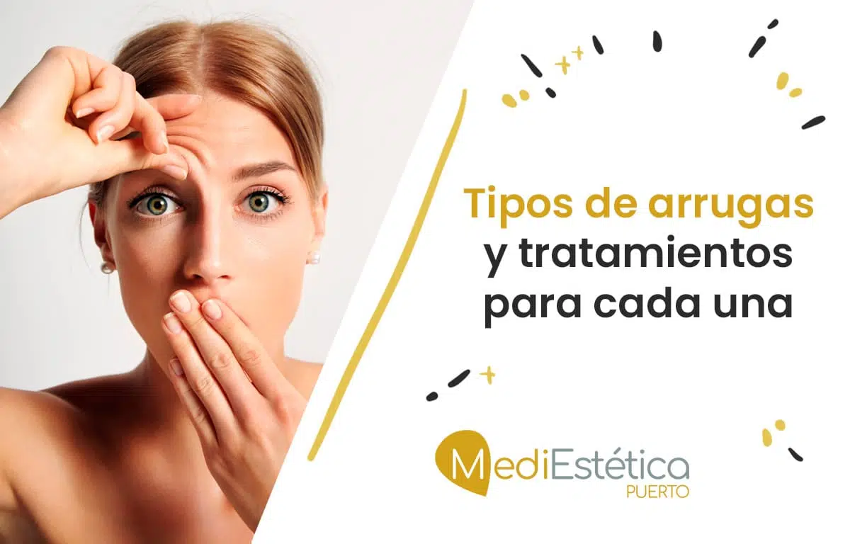 tipos de arrugas y sus tratamientos