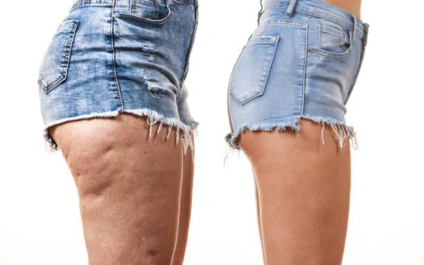 celulitis antes y después