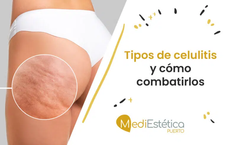 tipos de celulitis y mejores tratamientos