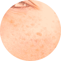 lentigo solar manchas en la piel tratamientos