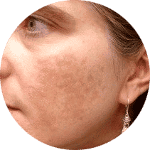 melasma manchas en la piel tratamiento