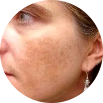 melasma manchas en la piel tratamiento