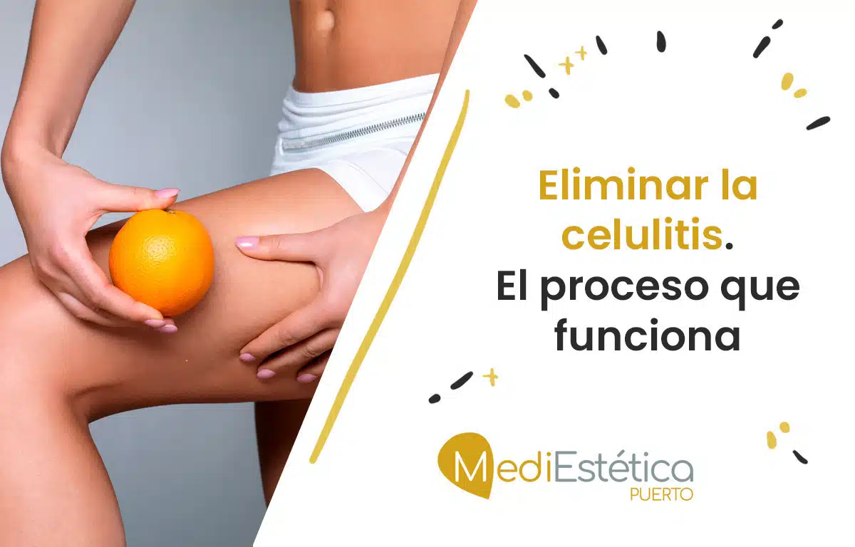 eliminar la celulitis el proceso que funciona