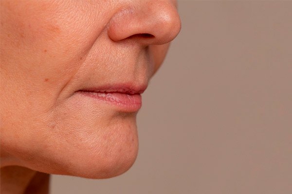 flacidez facial como tratar cadiz
