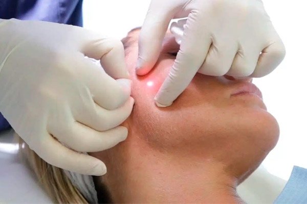tratamiento endolift cadiz el puerto de santa maria mediestetica puerto
